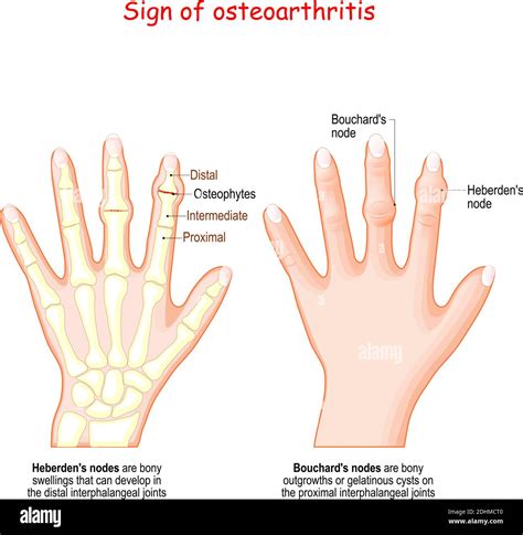 Sign of osteoarthritis. Human hand with Heberden's node and Bouchard's ...
