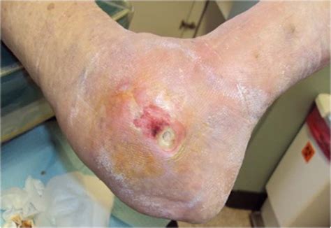 diabetic ankle fracture | The Foot and Ankle Online Journal