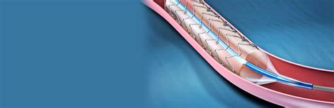 How safe is the primary PCI? | Dr. Viveka Kumar