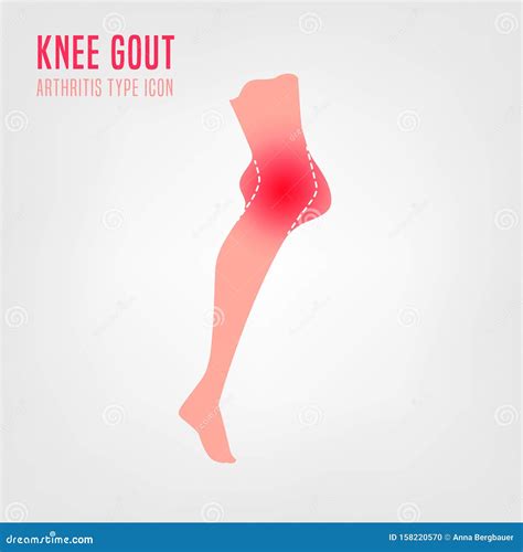 Gout arthritis icon stock vector. Illustration of gouty - 158220570