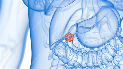 Image result for Gallbladder Cancer