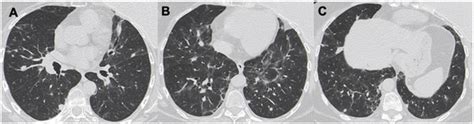 Primary Lymphoproliferative Lung Diseases: Imaging and ...