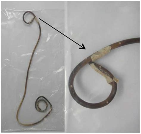 Double J Stent Removal