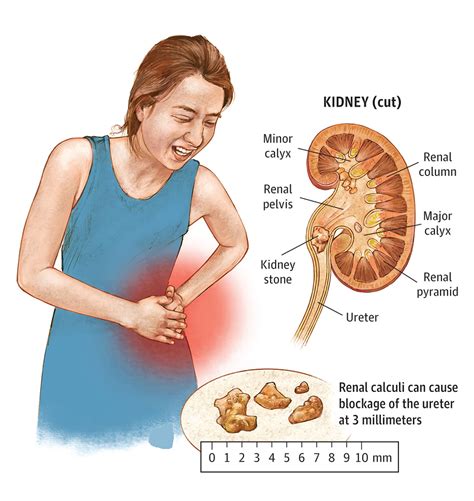Kidney Stone, Causes, Prevention & Natural Home Remedy Kidney Stone