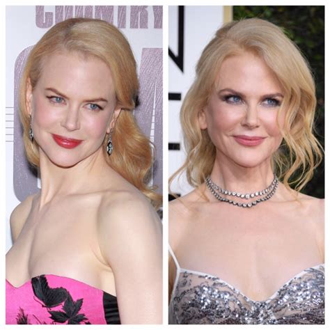 Did Nicole Kidman Have Plastic Surgery? See Transformation