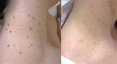 Skin Tag Removal Treatment in Kurnool, Bangalore, Hyderabad and India