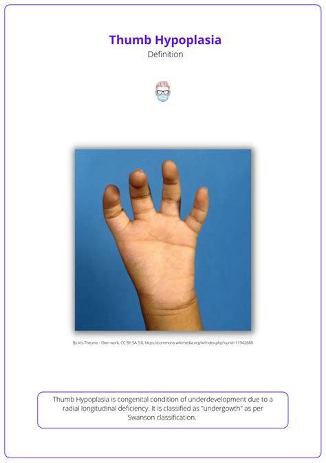 Thumb Hypoplasia: Blauth Classification, Diagnosis, & Treatment
