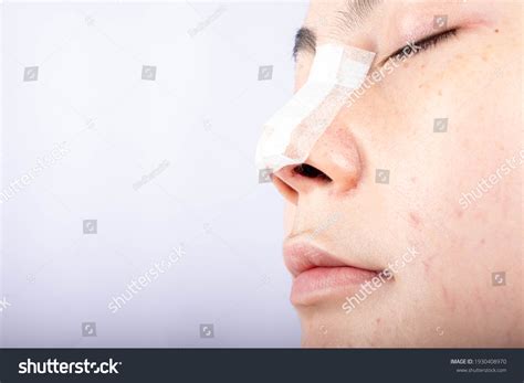 Bruised Nose: Over 1,371 Royalty-Free Licensable Stock Photos | Shutterstock