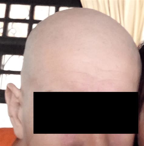 Image result for Diffuse Alopecia