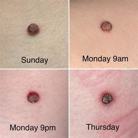 Mole Quickly Changed Then Fell Off : r/Melanoma