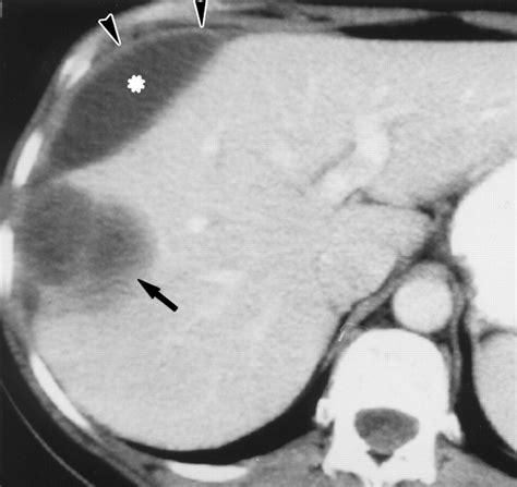 Subcapsular Abscess An Unusual CT Finding in Hepatic Fascioliasis | AJR