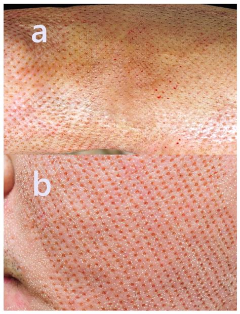 Five Cases of Skin Graft Scar Treatment Using the Pinholxell Method: A ...