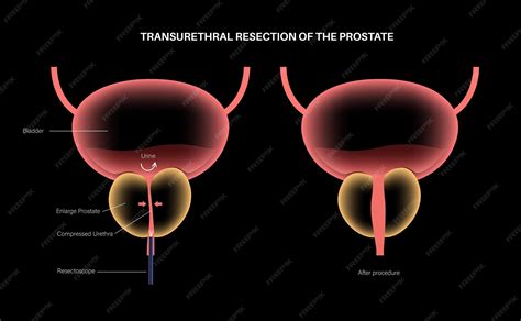 Résection transurétrale de la prostate TURP procédure médicale ablation chirurgicale d'une ...