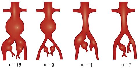 Endovascular treatment of hypogastric artery aneurysms - Journal of ...