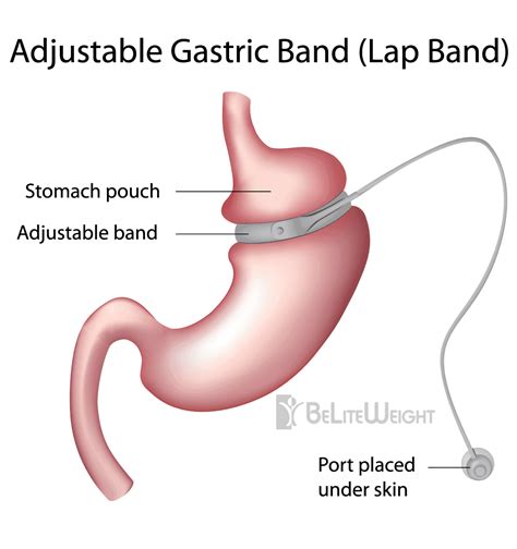 Adjustable, Laparoscopic Gastric Banding | Lap Band Procedures | Beliteweight