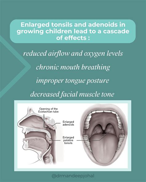 Enlarged Adenoids And Palatine Tonsil Image Tonsillitis And When Is