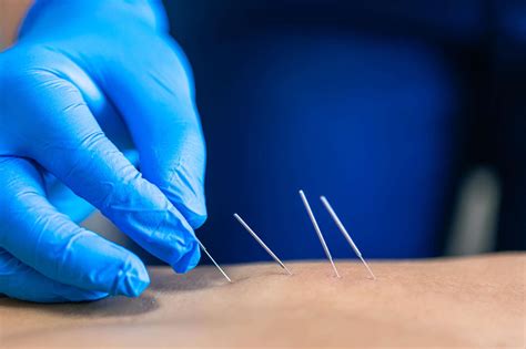 Dry Needling for Pelvic Pain Relief: Insights from Pelvic Floor Experts