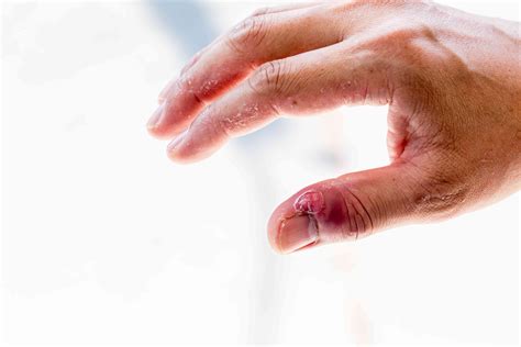 Skin Infection Around Fingernails and Toenails