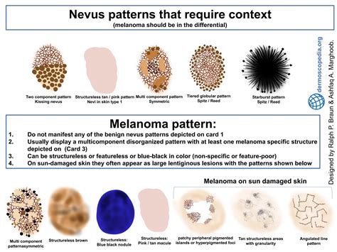 Características dermatosocpicas lesiones malignas dermoscopedia.org