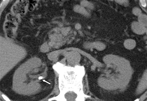 Kidney Stone Cat Scan