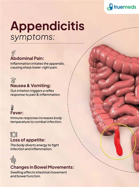 Does Appendicitis Pain Come Go