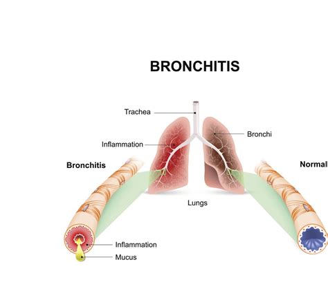Acute Bronchitis - Harvard Health