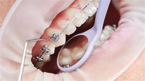 What Are the Hooks on Braces For?