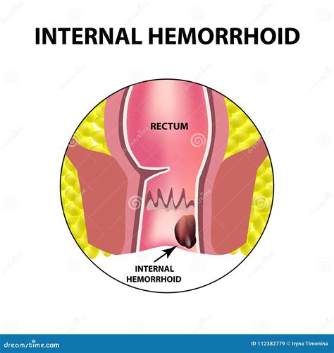 Hemorrhoids. Rectum Inflammation Causing Bleeding And Pain Vector ...