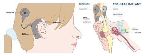 Average Cost Of Cochlear Implants: What To Expect In 2026