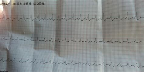 SVT w/Aberrancy? : r/ems