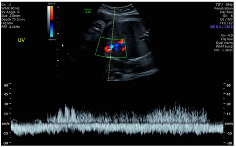 Perinatal Outcomes and Management of Umbilical Vein Varix: A Comprehensive Review of 392 Cases