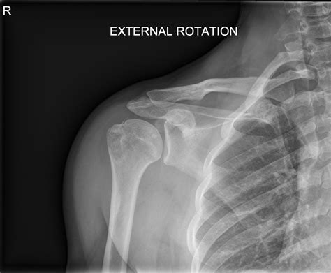 Humerus Greater Tuberosity Fracture X Ray at Evelyn Lawson blog