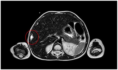 Primary Chest Wall Ewing Sarcoma: Treatment and Long-Term Results