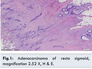 Double Primary Cancers Registered in Tertiary Care Hospital: Review of ...