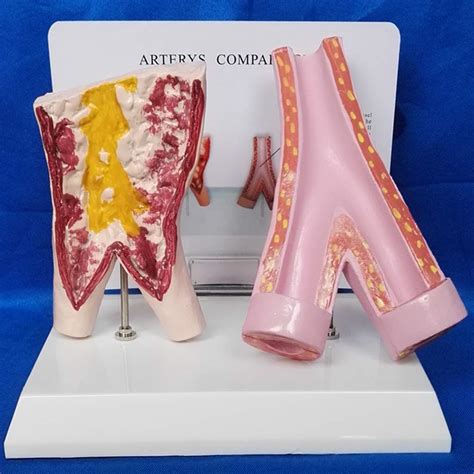 Buy Educational Model Comparison Model Between Smoking Blood Vessels ...