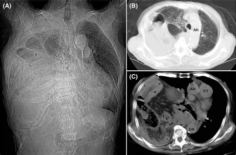 Right‐sided Bochdalek hernia in an elderly patient: a case review of ...