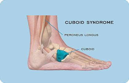 Cuboid Syndrome Treatment | Boston Foot Ankle Biologics