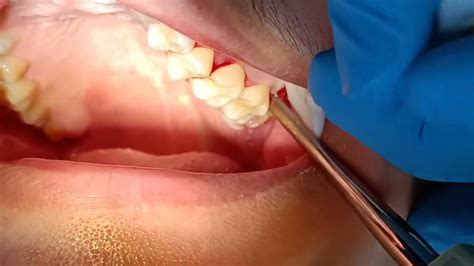 Image result for Healed Tooth Extraction