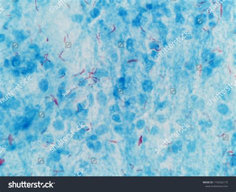 Comparison Of Ziehl Neelsen (ZN) Staining And Fluorescent, 44% OFF