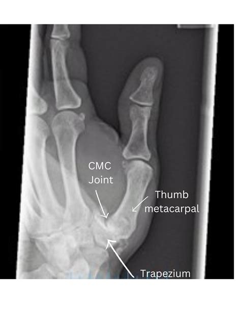 Thumb Arthritis | Denver, Colorado — Dr. Nick Golinvaux