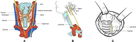 Frontiers | Echotexture of recurrent laryngeal nerves: the depiction of ...