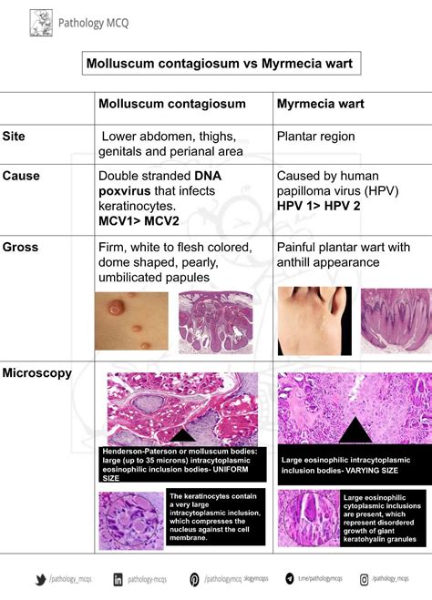 Molluscum contagiosum vs Myrmecia wart : r/pathologymcqs