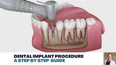 Tooth Implants Procedure 的图像结果