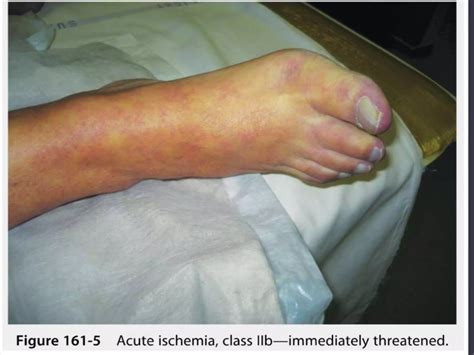 22.2.2018 acute limb ischemia vs critical limb ischemia | PPTX