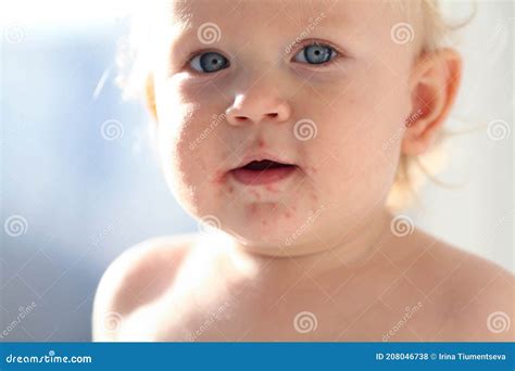 Portrait of a Baby with a Rash Near the Mouth. Enterovirus, Allergy in ...