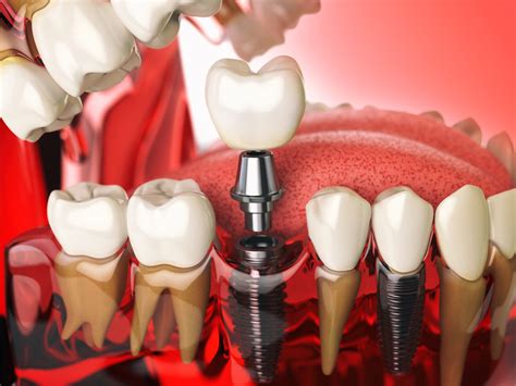 Dental Implants Fairfax, VA | Are Dental Implants Safe?