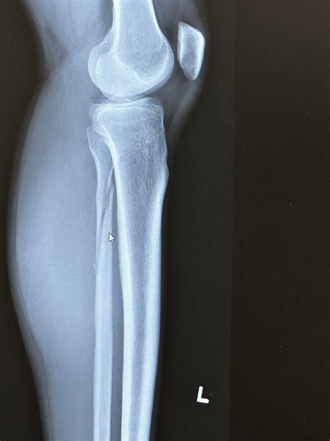 Fractured Fibula. How long till randori? : r/judo