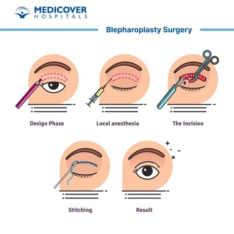 Blepharoplasty: አመላካቾች፣ ሂደቶች እና መልሶ ማግኛ