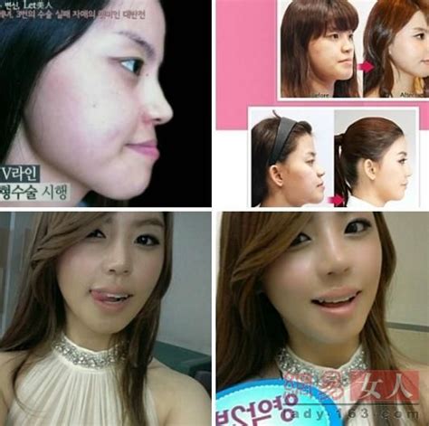 韩国丑女20万变脸 曝光韩式造美进化论|整形|手术|韩国_新浪时尚_新浪网