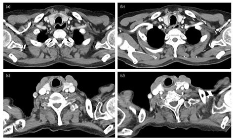 Evaluating the Image Quality of Neck Structures Scanned on Chest CT with Low-Concentration ...